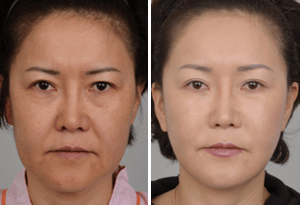 Surgical Face Lift Thailand